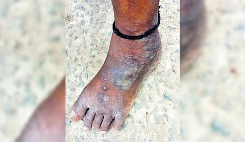 CPCB Report Exposes Toxic Heavy Metal Contamination at Hyderabad WTE Plants