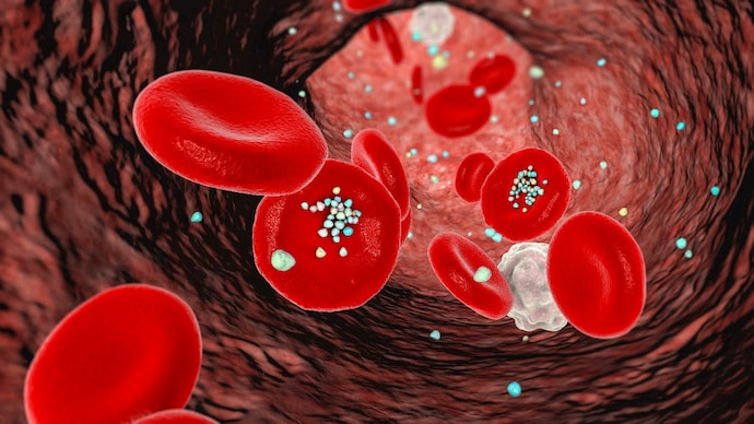 Microplastics Detected More Frequently in Heart Attack Patients Study Finds